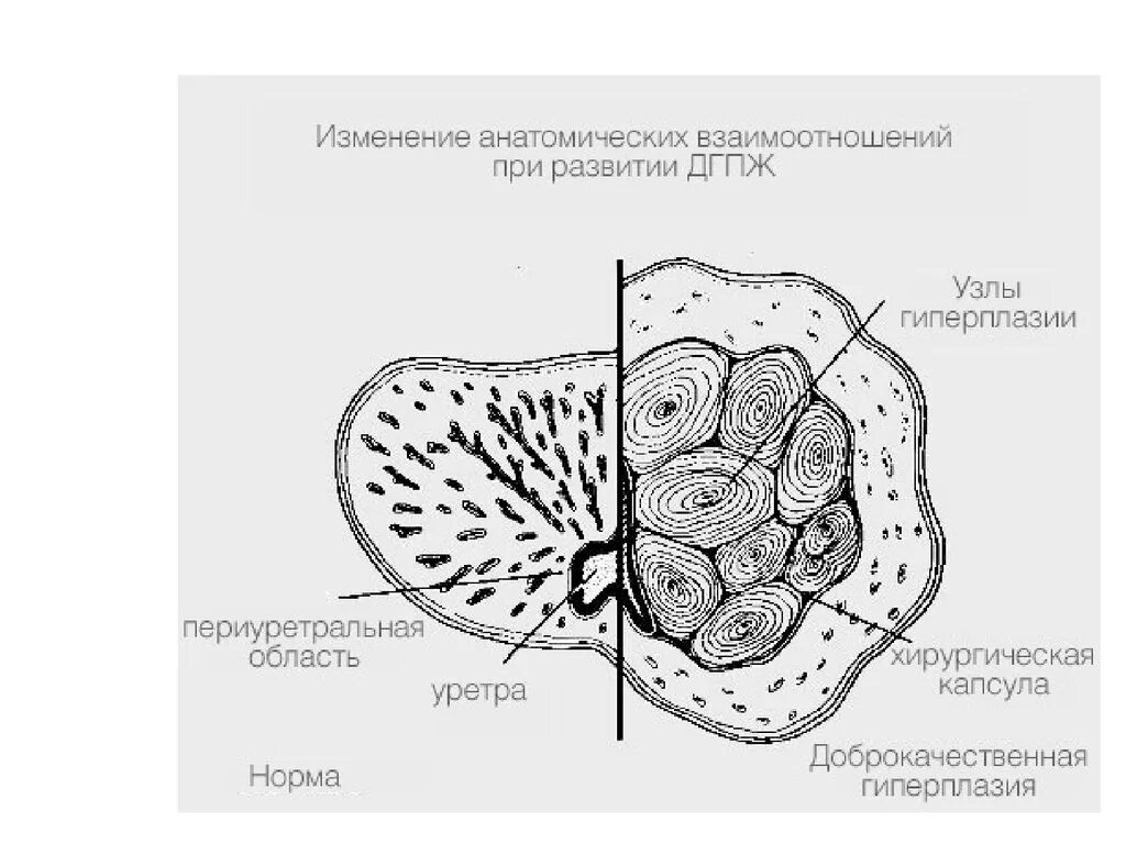 Предстательная железа капсула. Капсула предстательной железы. Хирургическая капсула предстательной. Хирургическая капсула предстательной железы на УЗИ. Простата зона периуретральных желез.