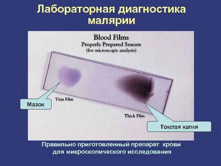 Для диагностики малярии забор крови осуществляют. Исследование толстой капли крови на малярию. Исследование толстой капли и мазка крови на малярию. Приготовления толстой капли крови, мазка крови.. Исследование в толстой капле малярия.