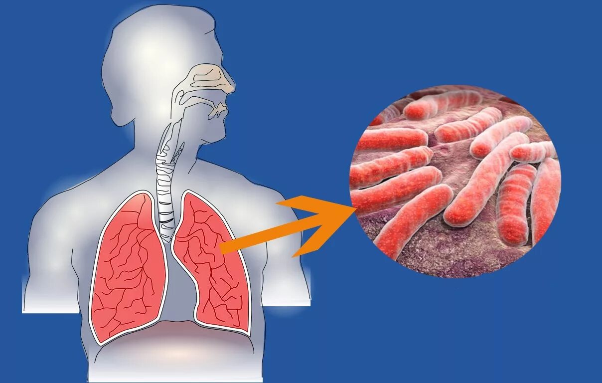 Туберкулез образ жизни. Туберкулез различных органов. Tuberkulyoz vnutrenniy organov.