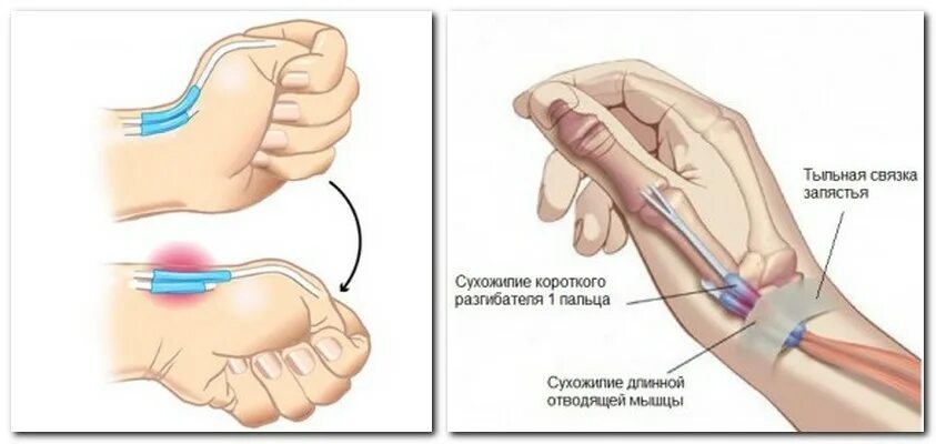 Растяжение связок лучезапястного мкб 10. Растяжение связок лучезапястного мкб 10