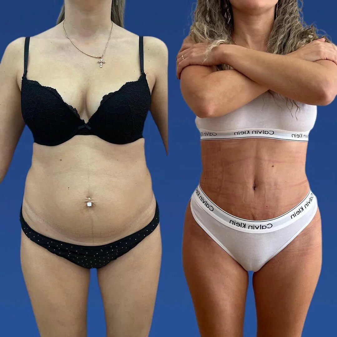 липофилинг тела