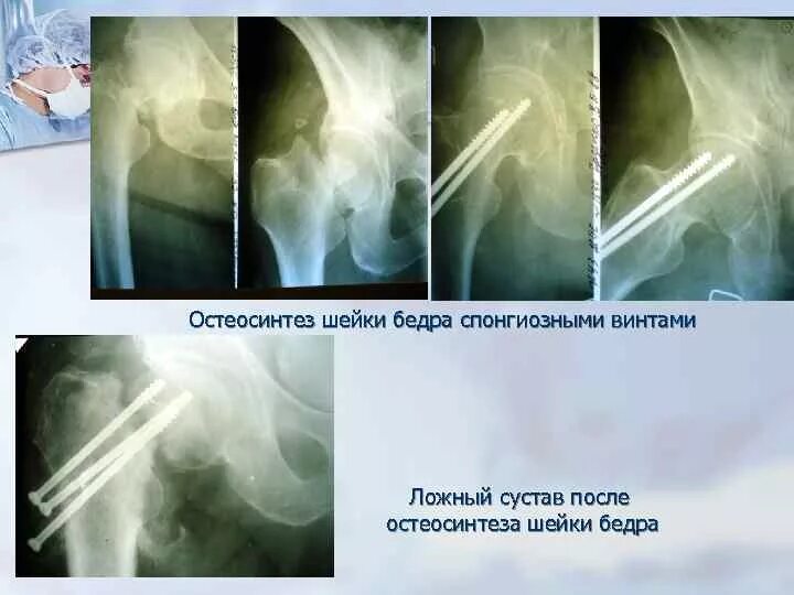 Операция остеосинтез шейки бедра. Остеосинтез перелома шейки бедра канюлированными винтами. Мос шейки бедра винтами. Остеосинтез тазобедренного сустава DHS. Остеосинтез 3 канюлированными винтами шейки бедра.