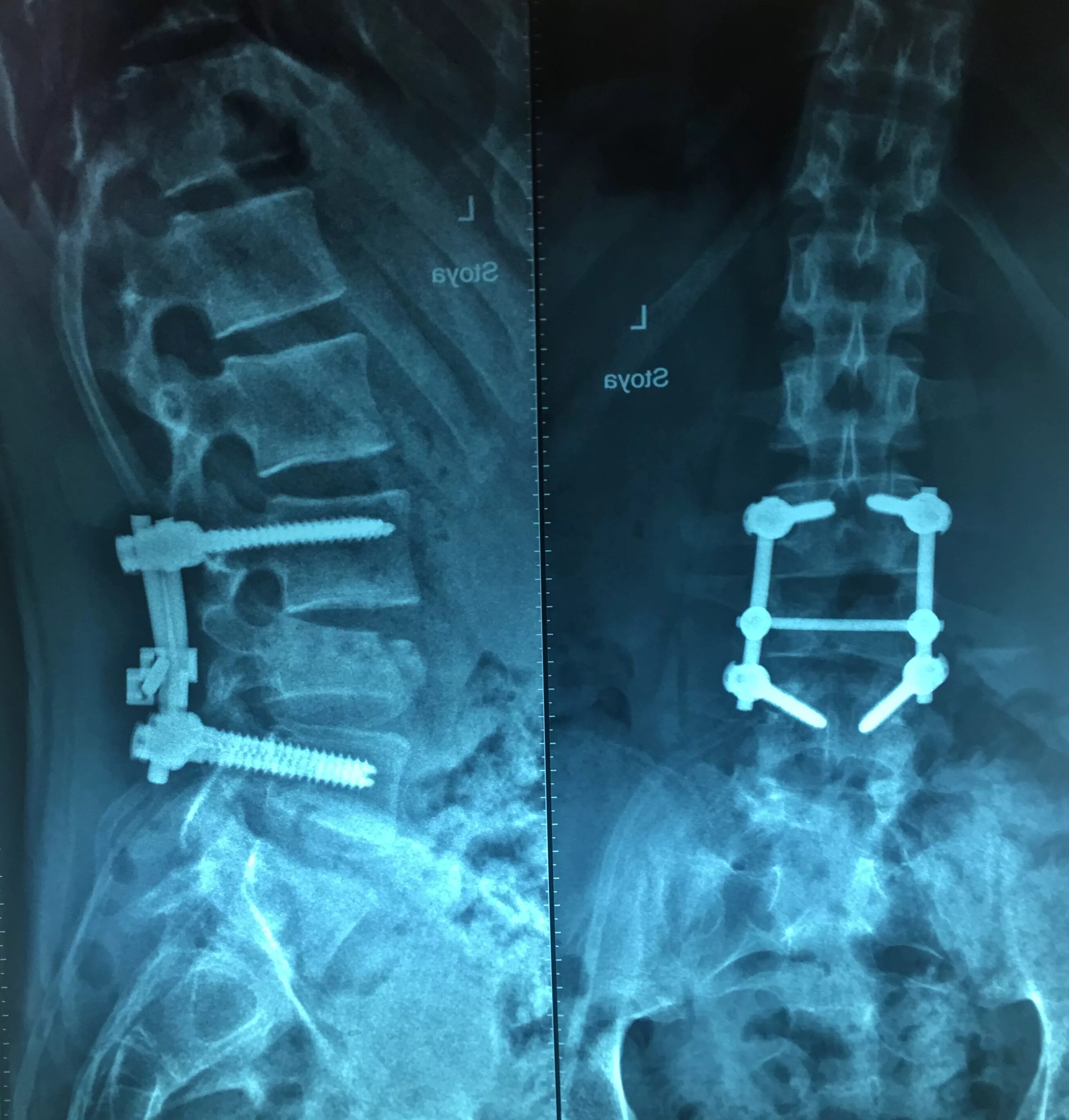 Операция на позвоночнике поясница. Спондилодез вертебропластика. Задний спондилодез l5 l6. Задний спондилодез поясничного отдела. Спондилодез СРТ.