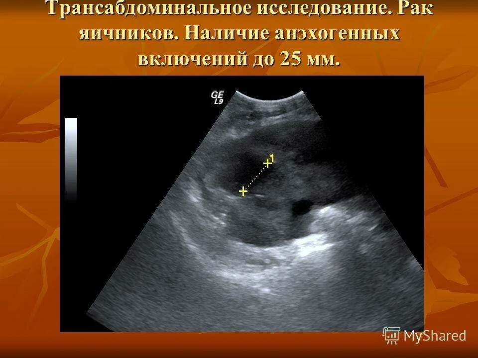 Образование округлое в яичнике. Яичники трансабдоминальное УЗИ. Трансабдоминальное УЗИ малого таза. Киста яичника УЗИ трансабдоминальное. УЗИ придатков трансабдоминальное что это.