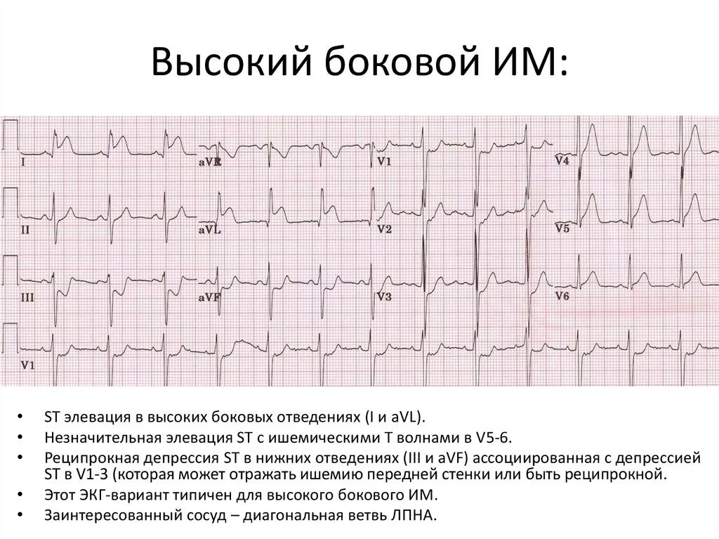 Изменения миокарда предсердий. Острый инфаркт миокарда передней стенки ЭКГ. ЭКГ инфаркт миокарда, рубцовые изменения. Переднераспространенный инфаркт ЭКГ. ЭКГ при высоком переднем инфаркте миокарда.