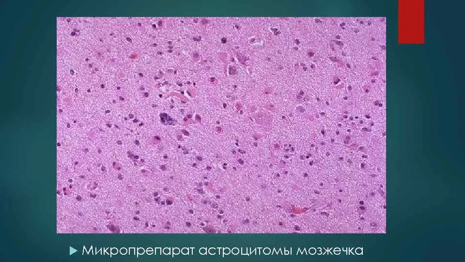 Микропрепарат головного мозга. Астроцитома патанатомия. Головной мозг микропрепарат. Отек мозга микропрепарат. Астроцитома микропрепарат.