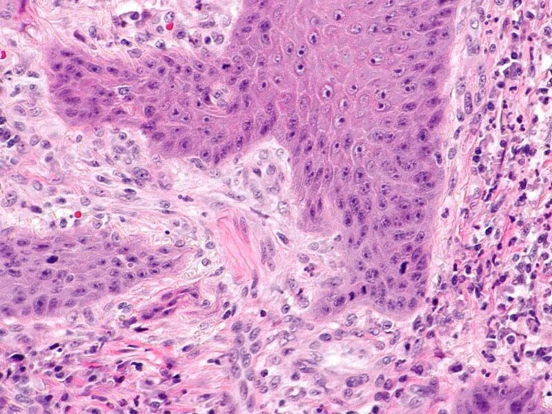 пэт-кт множественные метастазы.