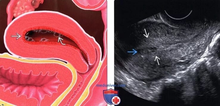 Эндометрий отслойка. Энтеробиозный эндометрит. Послеродовой эндометрит УЗИ.