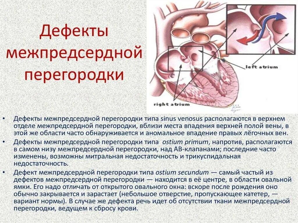 Где находится овальное окно. Врожденный порок сердца открытое овальное окно. ВПС открытое овальное окно. Врожденный порок сердца овальное окно. Открытое овальное окно 1,7 мм у ребенка.