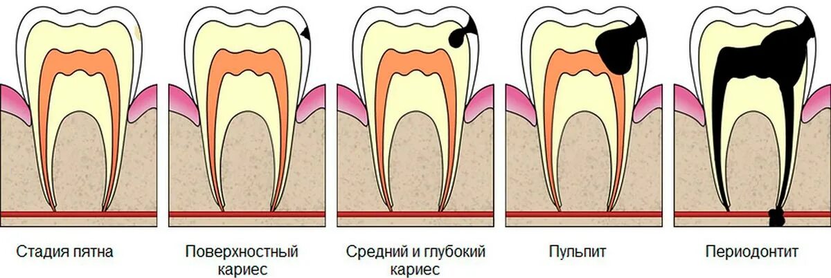 Как отличить зубную боль от воспаления. Кариес пульпит периодонтит. Классификация кариес пульпит периодонтит. Строение зуба кариес пульпит.