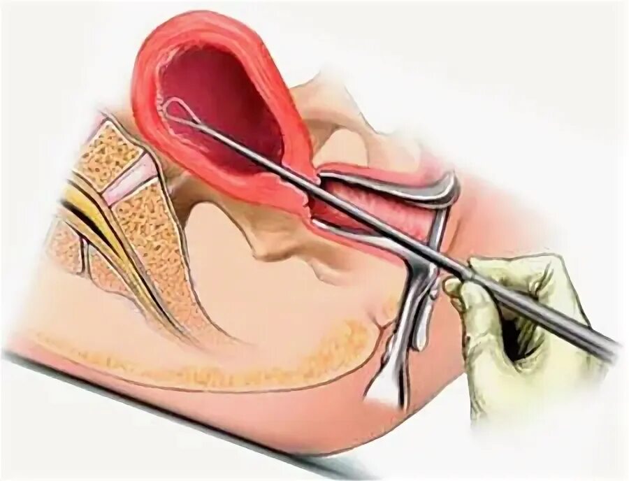 Маточное выскабливание. Хирургическое выскабливание полости матки. Раздельное диагностическое выскабливание полости матки. Выскабливание полости матки РДВ. Выскабливание цервикального канала шейки.