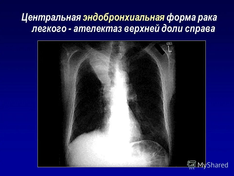 рак легкого ателектаз