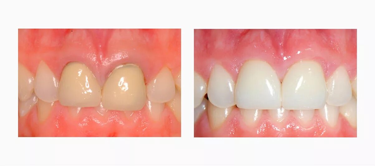 коронка металлокерамика или цирконий. безметалловая керамика диоксид циркония. металлокерамическая коронка и диоксид циркония. коронка металлокерамика или диоксид циркония что лучше. безметалловая коронка диоксид циркония.