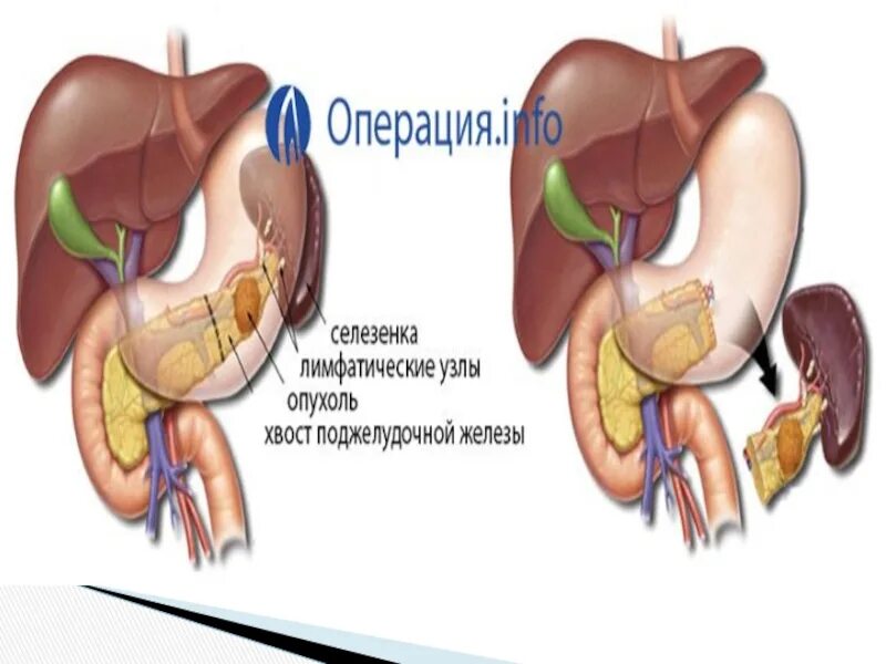 Спленэктомия что это. Спленэктомия этапы операции. Регенерация селезенки.
