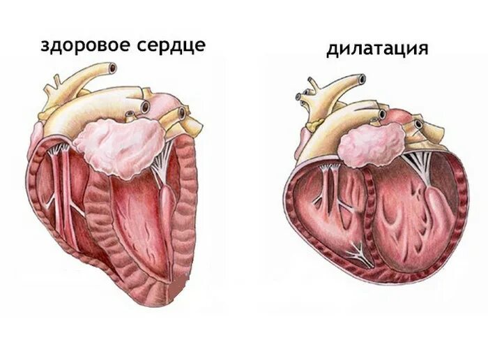 Расширение полостей сердца дилатация. Дилатация полости левого желудочка. Расширение правого и левого желудочка и правого предсердия. Дилатация желудочков сердца. Дилатация полостей предсердий