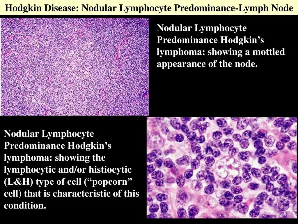 История лимфомы. Клетки Ходжкина гистология. Лимфоцитарная лимфома Ходжкина. Клетки при лимфоме Ходжкина. Лимфома Ходжкина микропрепарат.