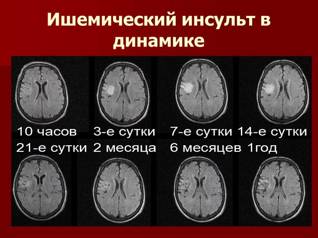 Поражение головного мозга при инсульте. Ишемия ишемический инсульт мозга. Осложнения ОНМК ишемический инсульт. Ишемический инсульт очаг поражения. Очаг ишемического инсульта на мрт.