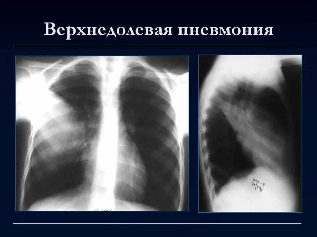 крупозная пневмония рентген. хламидийная пневмония рентген. пневмония рентген описание. казеозная пневмония рентгенограмма. госпитальная пневмония рентген.