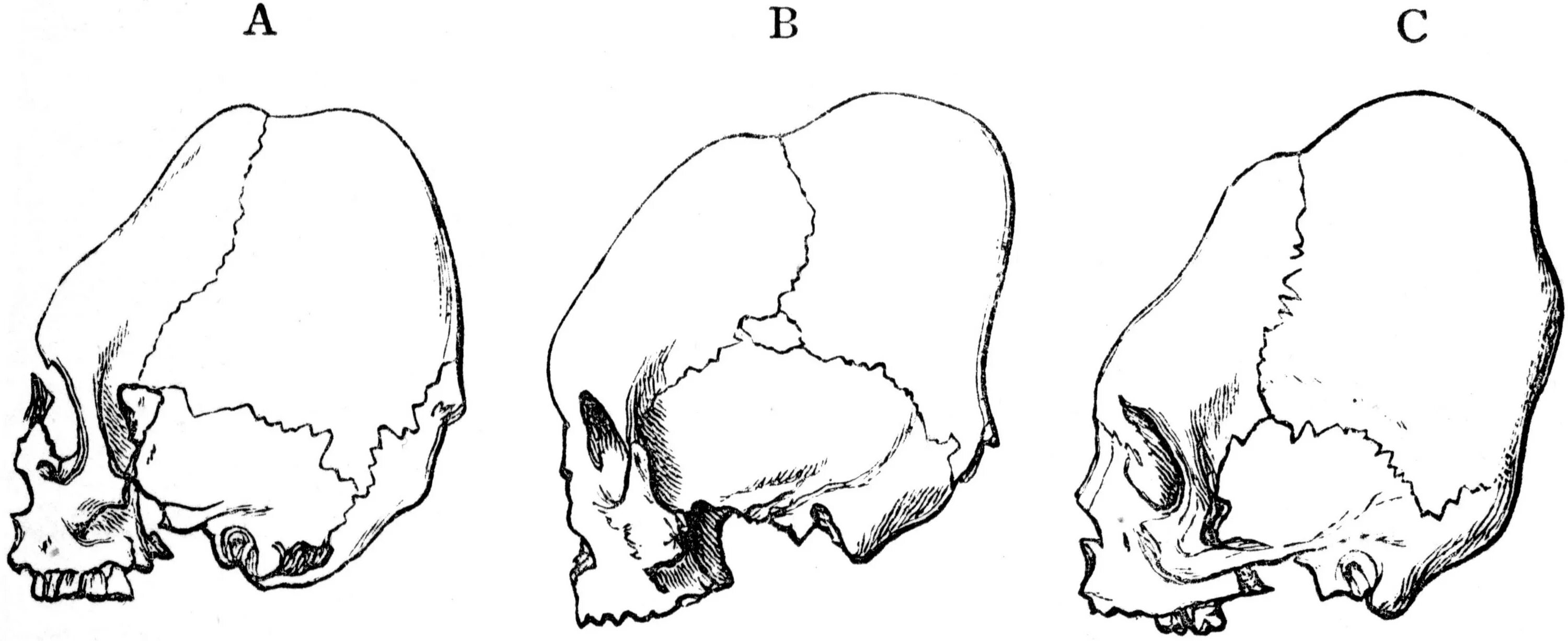 Варианты формы черепа. Аномальные формы черепа. Деформация формы черепа.