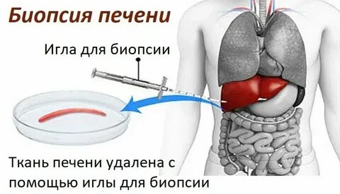 Противопоказания к биопсии печени