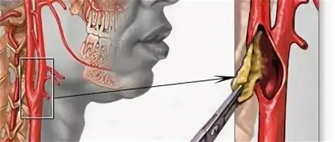 Удаление сонной артерии операция