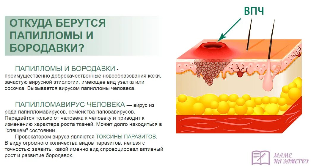 Подошвенная бородавка вирусная инфекция.