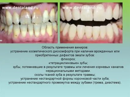Лечение флюороза
