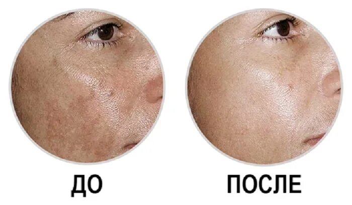 Пигментация на лице как избавиться. Осветление пигментных пятен. пигментация после крема.