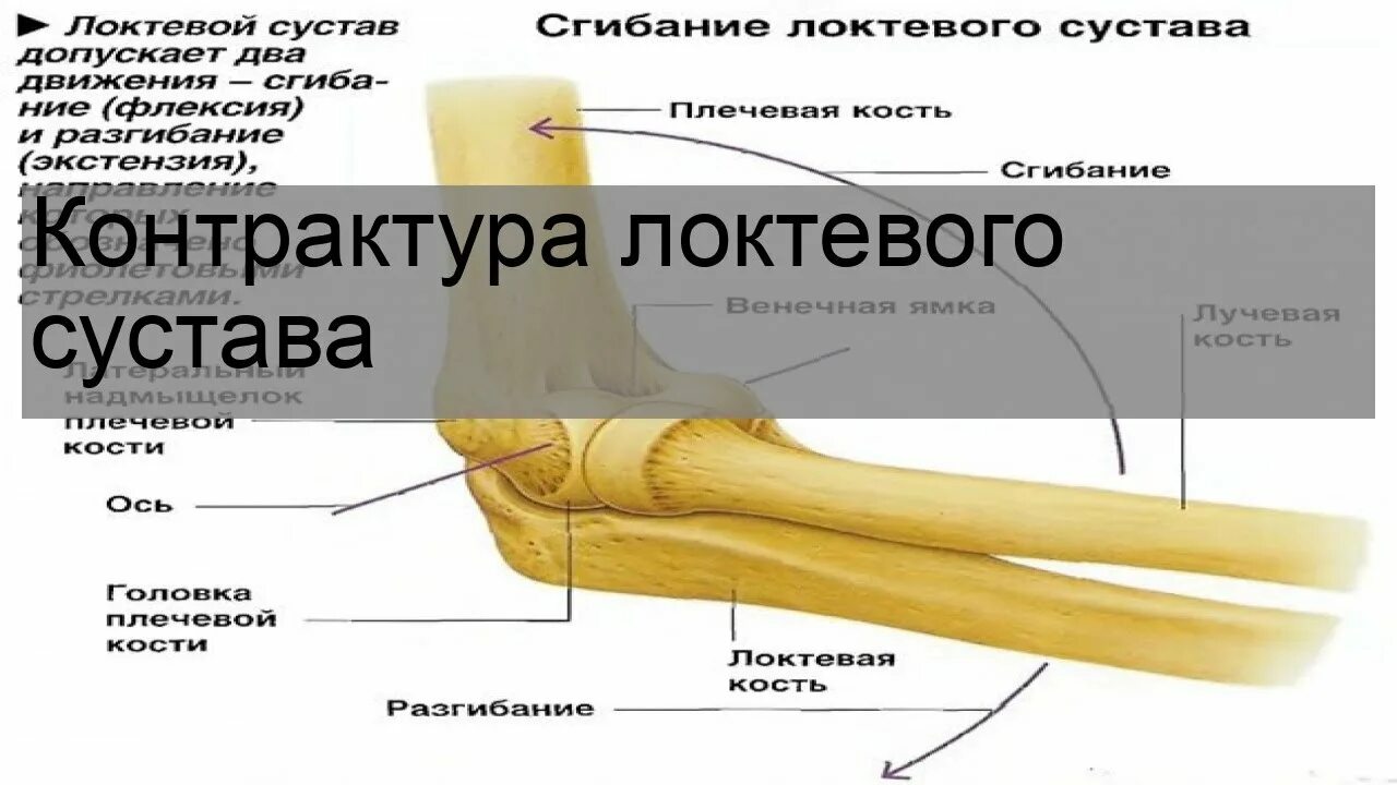 Какой врач лечит локтевые суставы. Контрактура локтевого сустава. Разработка контрактуры локтевого сустава. Контрактура левого локтевого сустава. Ротационная контрактура локтевого сустава.