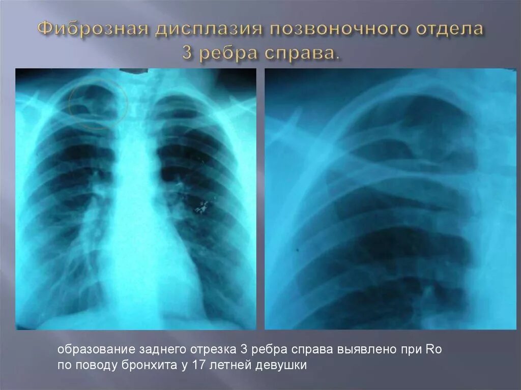 Фиброзная дисплазия кости. Дисплазия ребра. Дисплазия ребра. Фиброзная дисплазия рентген. Фиброзно-кистозная дисплазия кт.