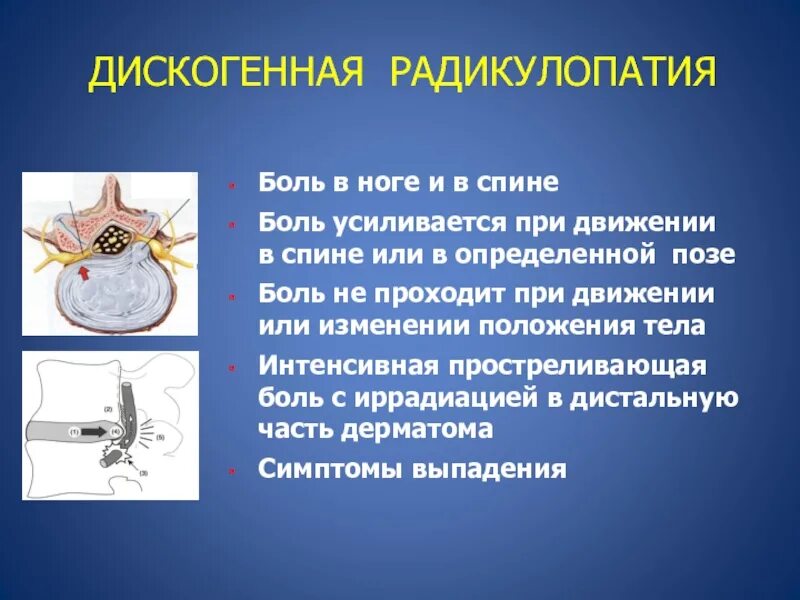 Поясничная радикулопатия лечение. Радикулопатия. Дискогенная радикулопатия. Боль при радикулопатии. Симптомы радикулопатии.