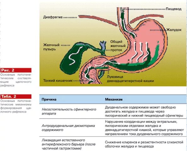 Желчь в желудке причины. Выбрасывание желчи в желудок. Заброс желчи в желудок причины.