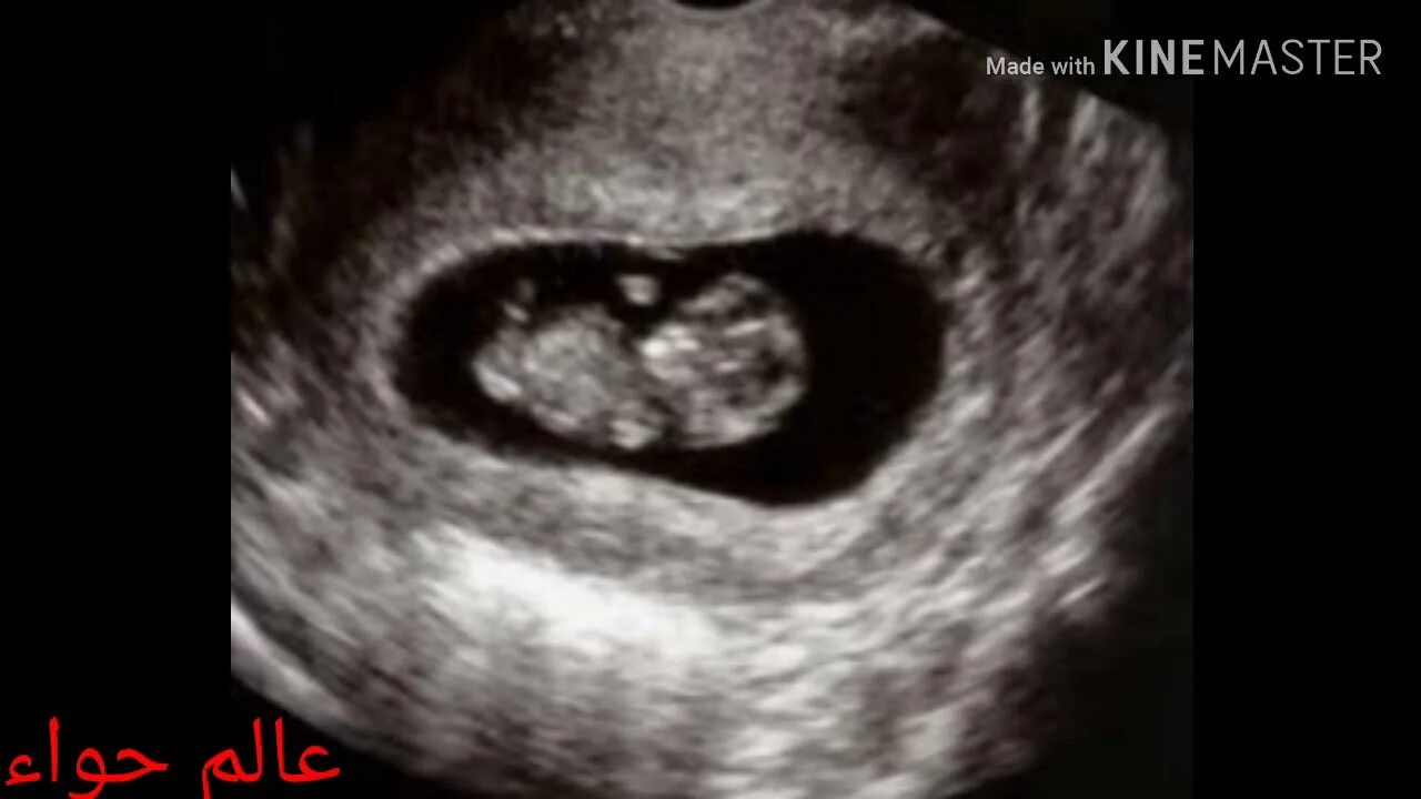 Эмбрион на 9 неделе беременности УЗИ. УЗИ на 9 акушерской неделе беременности. Фото УЗИ на 9 неделе беременности акушерской. Почему на 10 неделе беременности