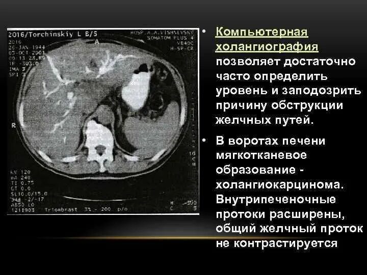 Образование в воротах печени. Внутрипеченочный желчный проток на кт. Расширение желчных протоков мрт. Расширение внутрипеченочных протоков на кт. Обжий желочный протокпечени на кт.