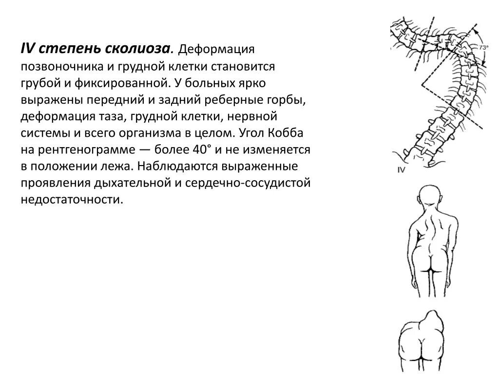 Сколиоз 1 степени грудного отдела. Сколиоз 2 степени угол искривления 17. Сколиоз 3 степени 26 градусов. Сколиотическая деформация th6-l1. Сколиоз 2 степени это