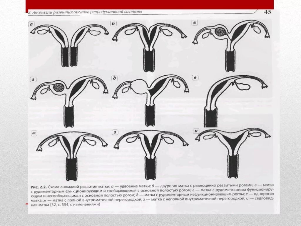 Протокол аномалии развития матки. Аномалии развития матки классификация. Пороки развития матки и влагалища. Аномалии развития женских половых органов.