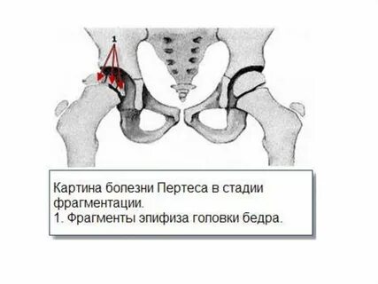 Болезнь пертеса у детей
