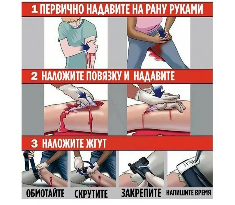 Мероприятия по остановке кровотечения. Памятка остановка кровотечения. памятка по остановке кровотечения. памятка как останавливать внутреннее кровотечение. памятка остановка кровотечения 3 видов.