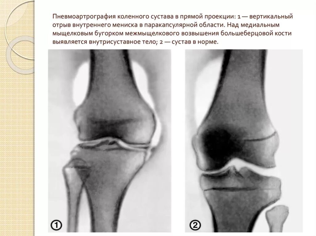 Два мыщелка. Мениск коленного сустава рентген. Повреждение мениска на рентгене. Повреждение мениска коленного сустава рентген. Перелом мениска коленного сустава рентген.