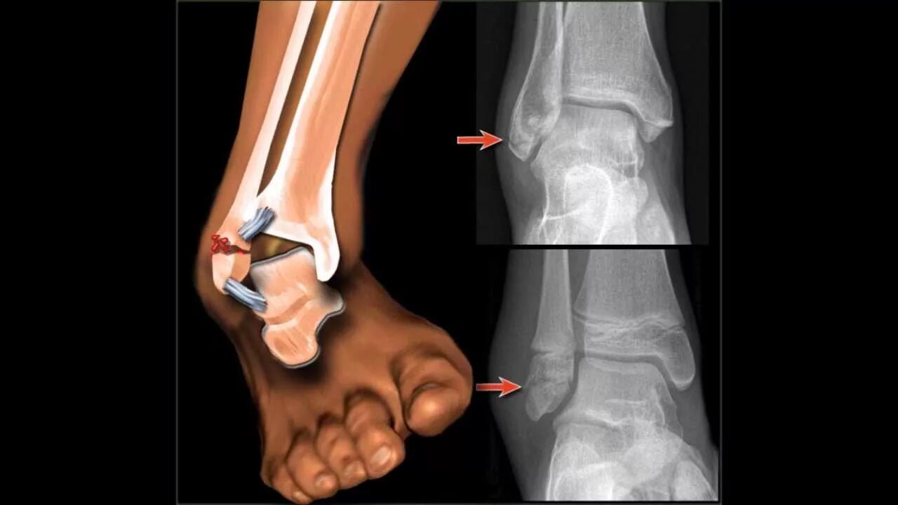 Трещина в организме. Ладьевидная кость голеностопного сустава. Перелом ладьевидной кости ноги. Ладьевидная кость стопы вывих. Трехлодыжечный перелом.