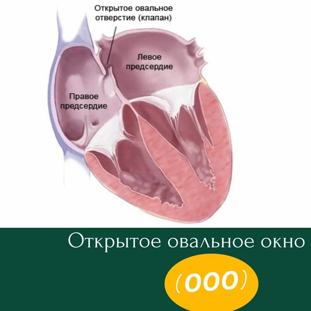Открытое овальное окно в сердце. Впс открытое овальное окно. Открытое овальное окно в сердце операция. Окно межпредсердной перегородки. Функционирующее открытое овальное окно у новорожденных.