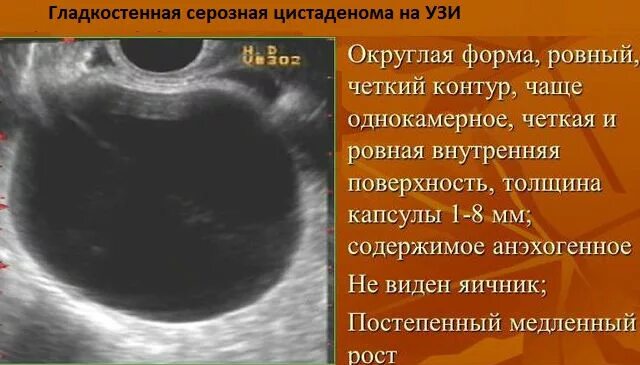 2 в яичниках образуются. Муцинозная цистаденома яичника на УЗИ. Серозная цистаденома яичника на УЗИ. Образование яичника на УЗИ.