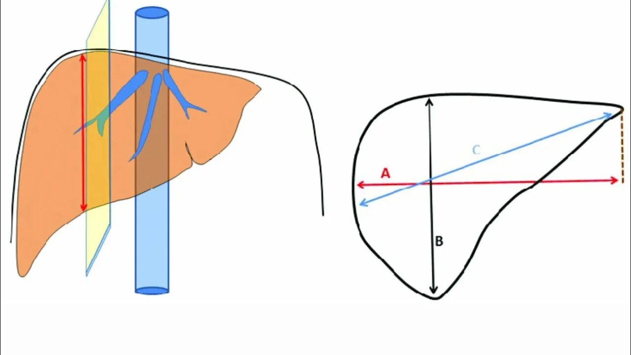 4 размера печени. Краниокаудальный размер правой доли печени. Краниокаудальный размер печени на кт. Ультразвуковая анатомия печени Изранов. УЗИ печени Изранов.