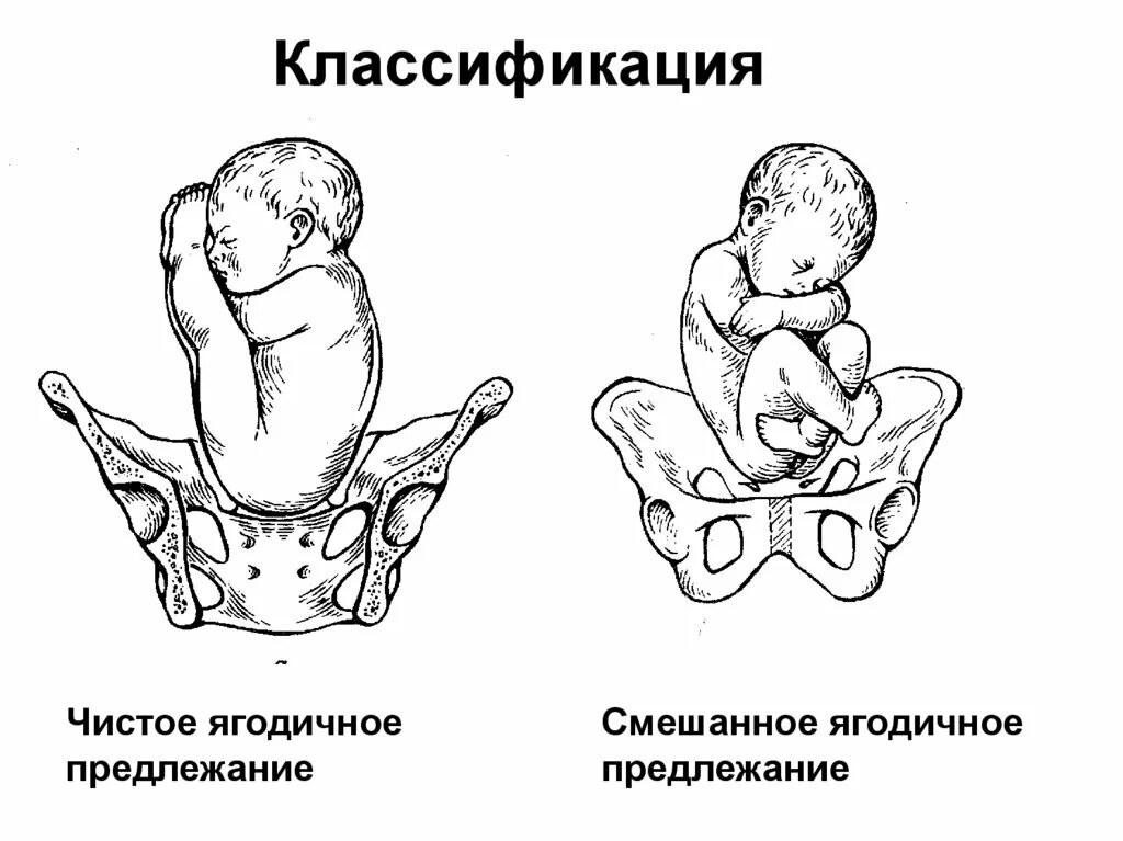 Классификация тазовых. Тазовое ножное предлежание плода. тазовое предлежание смешанное ягодичное. тазовое предлежание чисто ягодичное. классификация тазовых предлежаний.
