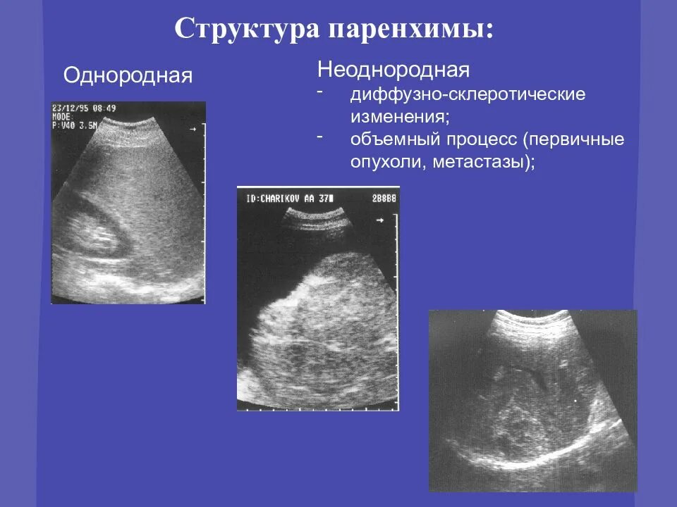 Печень диффузно неоднородная что это. Неоднородная паренхима печени УЗИ. Паренхима печени однородная. Структура паренхимы печени неоднородная что это. УЗИ структура паренхимы неоднородная.