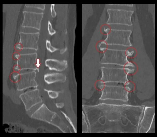 Деформирующий спондилез шейного отдела рентген. Деформирующий спондилез рентген. Спондилёз поясничного отдела позвоночника на кт. Спондилоартроз пояснично-крестцового отдела позвоночника на кт. Картина спондилеза
