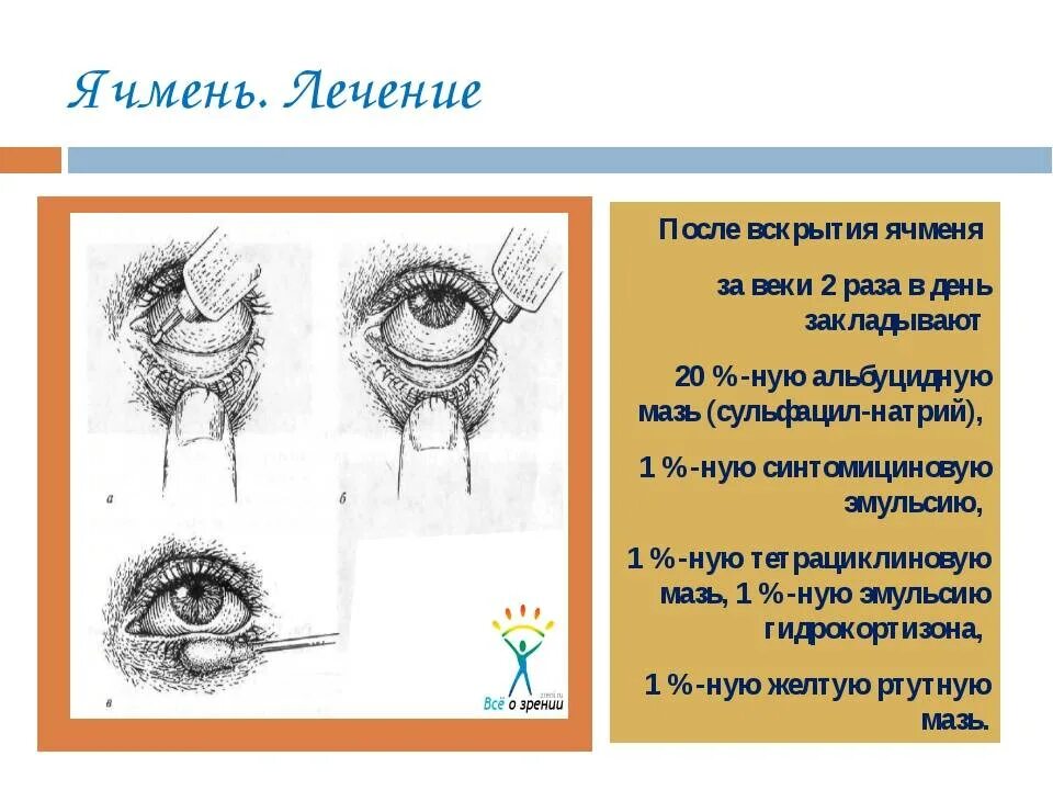 Лечение ячменя на нижнем. Этапы формирования ячменя на глазу. Заболевания век ячмень.