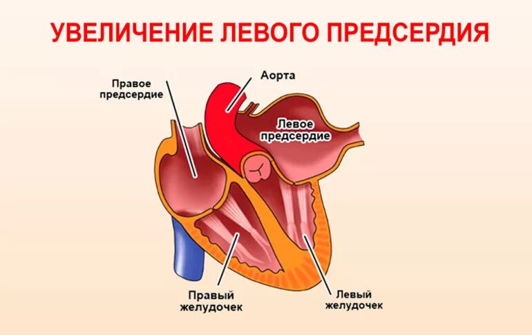 Желудочка сердца расширена. Левое предсердие. Правое предсердие. Левое предсердие сердца. Увеличение левого предсердия.
