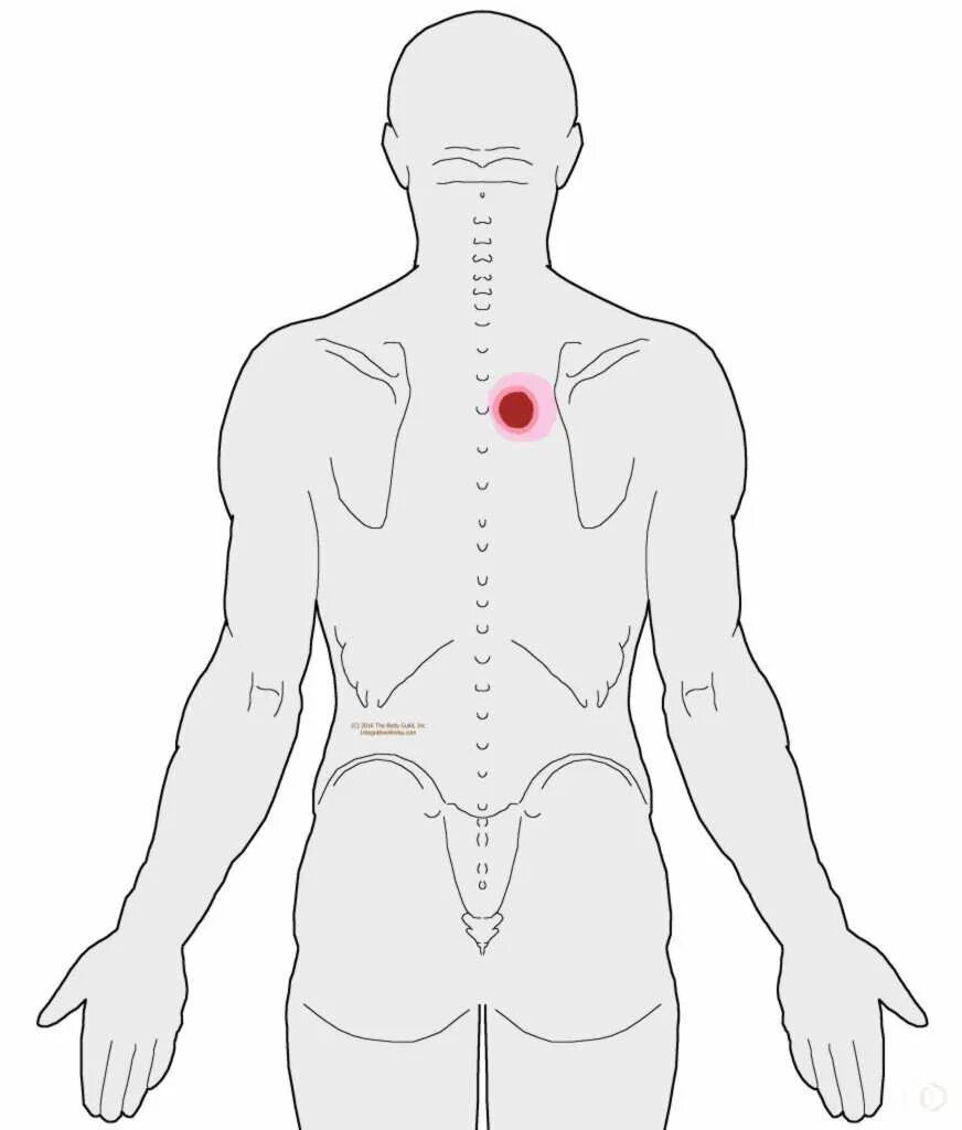 Иррадиация поясницы. Точка между лопатками. Болит между лопатками. Спина болит между лопатками. Точка на спине между лопатками.