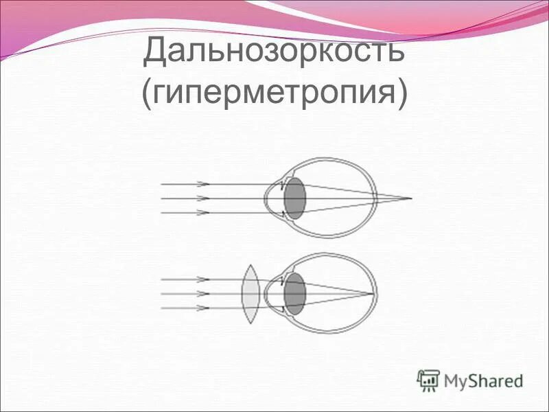 гиперметропия причины
